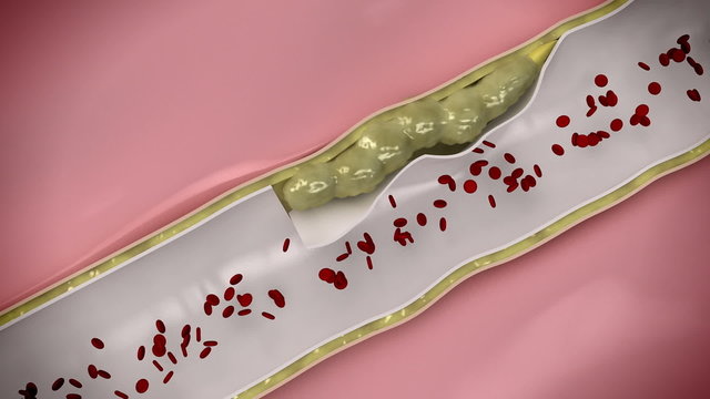 Coronary embolus travels through the circulatory system