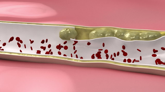 Coronary embolus cartoon look