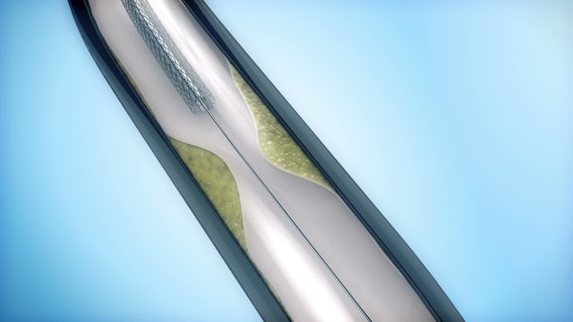 Stent is mounted on balloon catheter