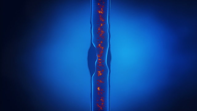 Formation of Plaque in the Arterial Wall