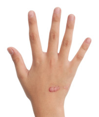 Fototapeta premium hands of the child with scar