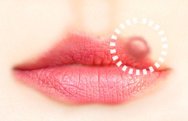 Close up of lips affected by herpes (cold sore) - obrazy, fototapety, plakaty