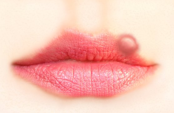 Close up of lips affected by herpes (cold sore)