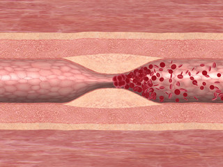 Blutgerinnsel in einer Arterie