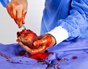 Surgeon busy with heart operation