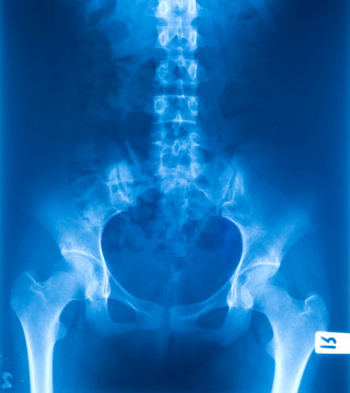 X-ray film of the pelvis