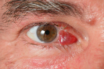 Healthcare, Closeup of human eye with hematoma