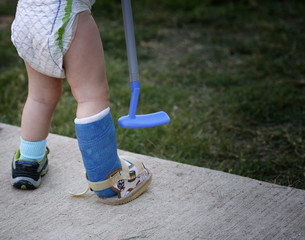 Toddler with fractured leg in cast