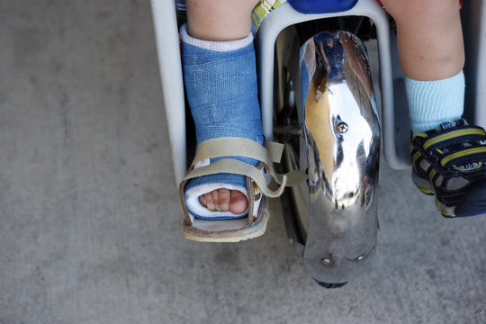 Toddler with fractured leg in cast