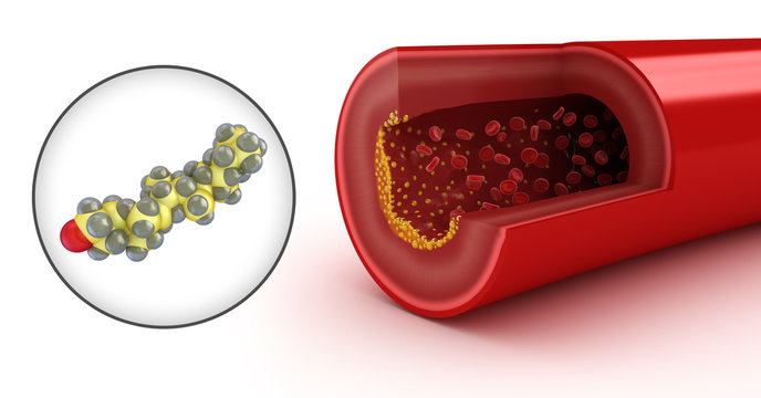 Cholesterol plaque in artery and cholesterol model