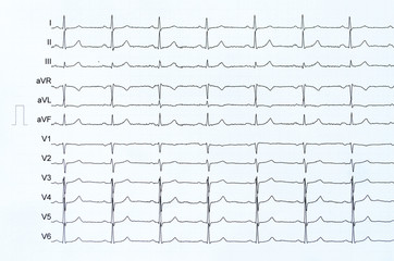 Herz Elektrokardiogramm formatfüllend (ohne Infarkt)