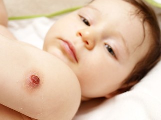 BCG vaccination wound on baby shoulder