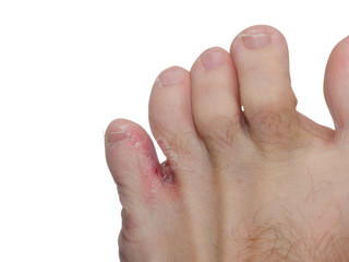 Athlete's foot (tinea pedis)