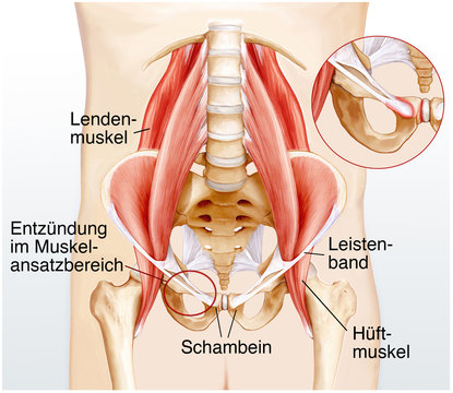 Schambeinentz&uuml;ndung