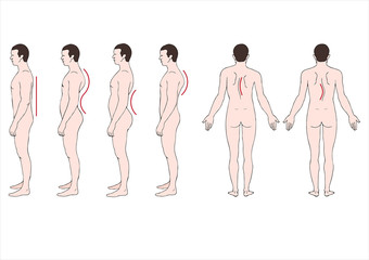 educational illustration deformstion of the spine&nbsp;