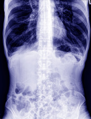 X ray of the abdomen 