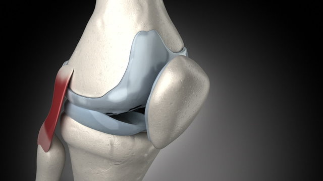 Painful knee arthritis animation