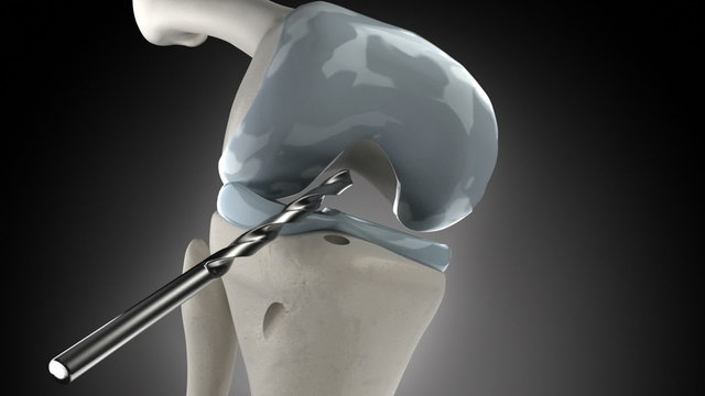 Knee arthroscopic cruciate ligament replacement stage