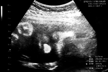image ultrasound  baby face