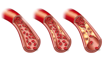 Arteriosclerosis, medically accurate 3D illustration showing healthy blood vessel and beginning  of arteriosclerosis