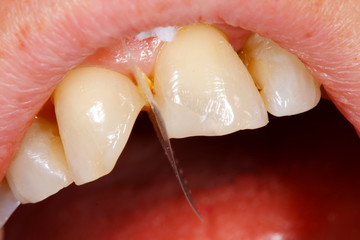 Comnposite filling tooth treatment