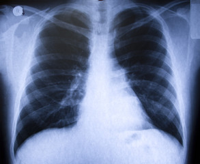 X-ray