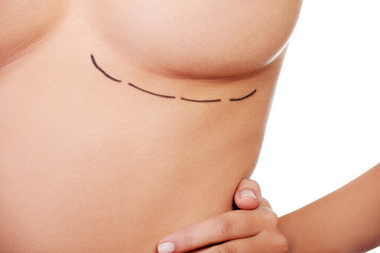 Woman breast marked out for cosmetic surgery