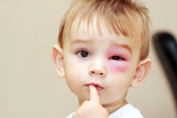 little boy - dangerous stings from wasps near the eye
