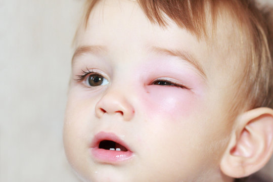 little boy - dangerous stings from wasps near the eye