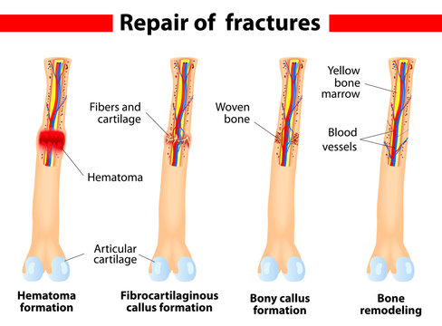 Fracture and repair. Vector scheme.