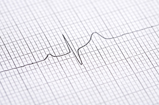 Electrocardiogram graph