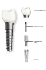 Zahnimplantat Modell