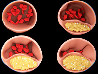 Arteriosklerose