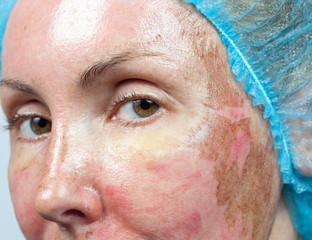 Cosmetology. New skin after a chemical peeling, - 46758063