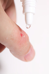 disinfect the scratch alcohol cuts hand health