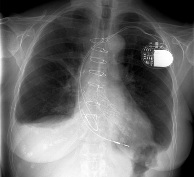R&ouml;ntgenbild Brustkorb Thorax Herzschrittmacher OP