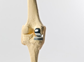 anatomic study model of an human knee replacement