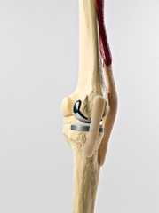 anatomic study model of an human knee replacement