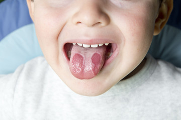 Niño con lengua geográfica mostrando los síntomas