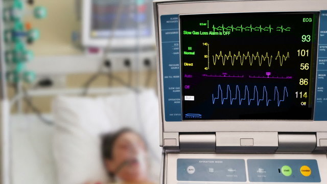 ICU patient with ECG monitor and intraaortic counterpulsation