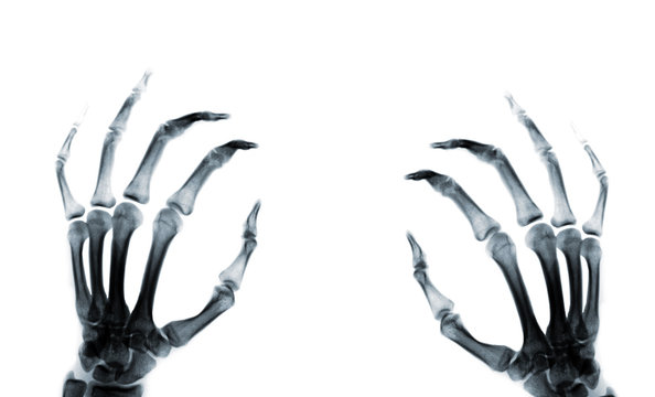 hand r&ouml;ntgen foto wei&szlig;
