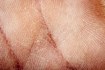 human dried skin