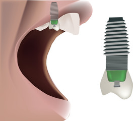 protesi dentale - dental prosthesis