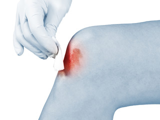 Fototapeta premium Hand disinfecting wound on hand knee.