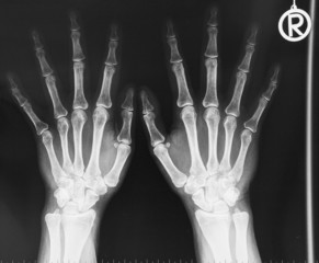 Röntgenbild - Hände