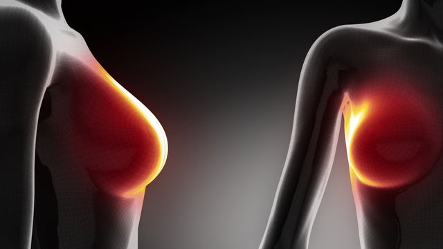 Mastectomía vídeos de archivo: 261 clips de vídeo HD y 4K ...