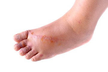 Fototapeta premium Wounds on women foot
