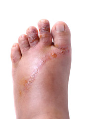 Wounds on women foot