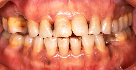 Discoloured teeth
