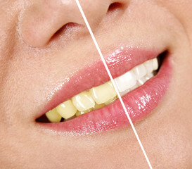 Whitening